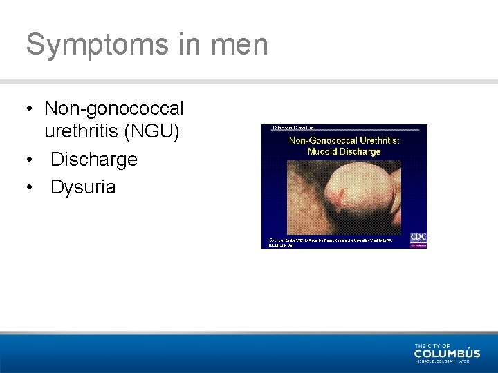 Symptoms in men • Non-gonococcal urethritis (NGU) • Discharge • Dysuria 