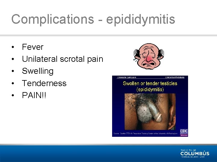 Complications - epididymitis • • • Fever Unilateral scrotal pain Swelling Tenderness PAIN!! 