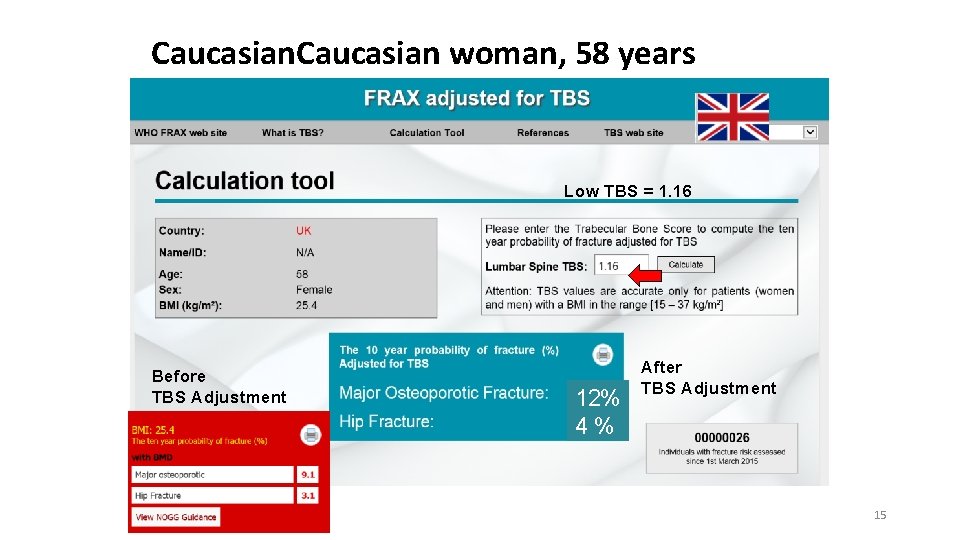 Caucasian woman, 58 years Low TBS = 1. 16 Before TBS Adjustment 12% 4%