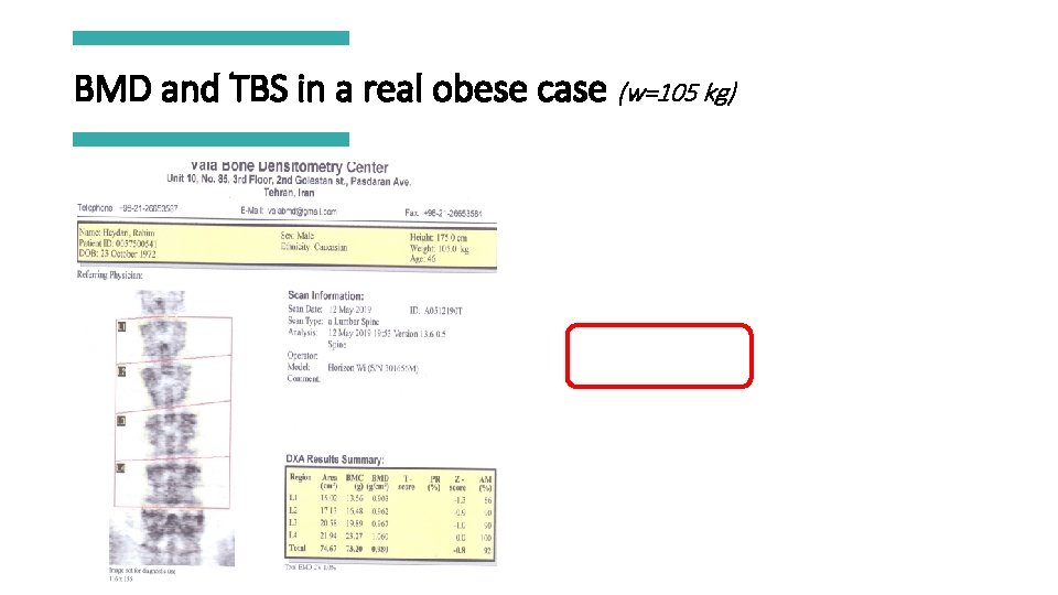 BMD and TBS in a real obese case (w=105 kg) 