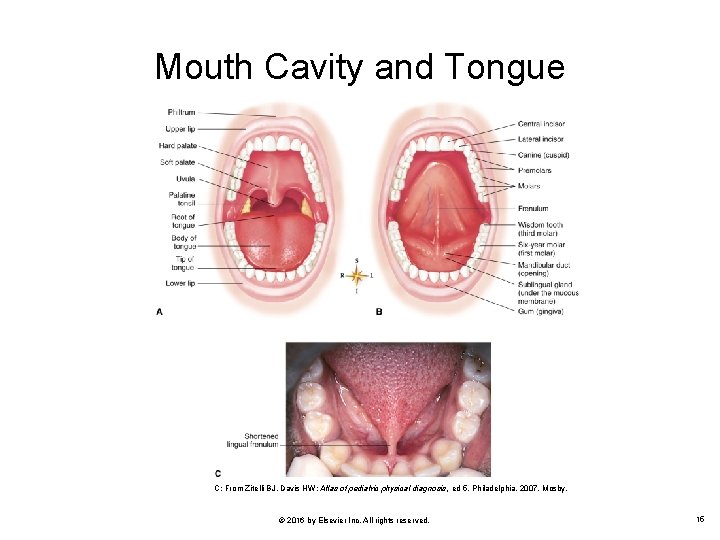 Mouth Cavity and Tongue C: From Zitelli BJ, Davis HW: Atlas of pediatric physical