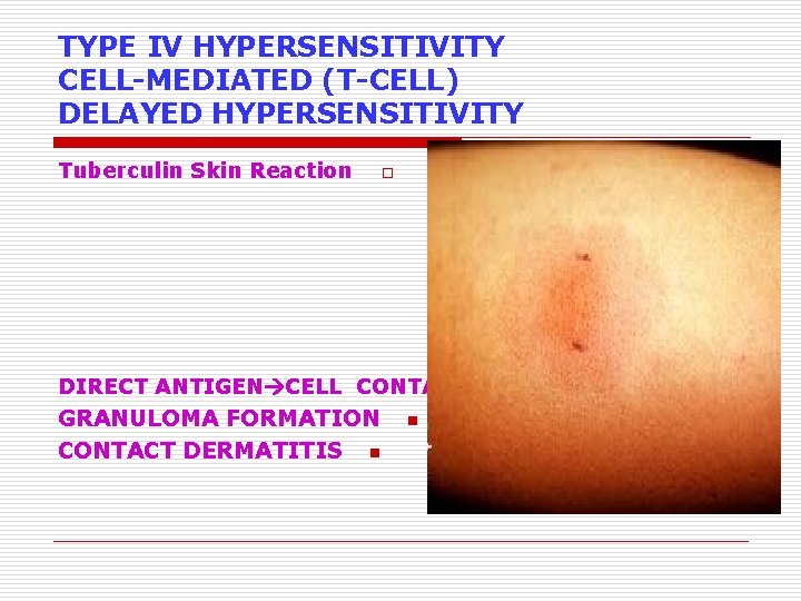 TYPE IV HYPERSENSITIVITY CELL-MEDIATED (T-CELL) DELAYED HYPERSENSITIVITY Tuberculin Skin Reaction o DIRECT ANTIGEN CELL