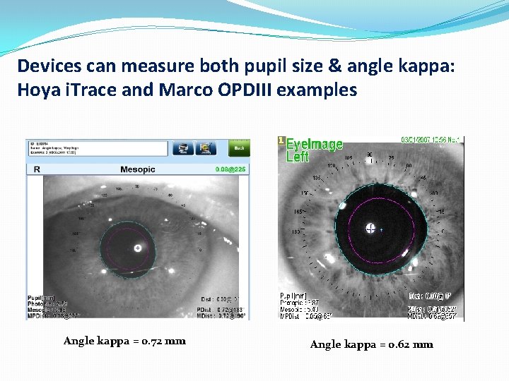 Devices can measure both pupil size & angle kappa: Hoya i. Trace and Marco