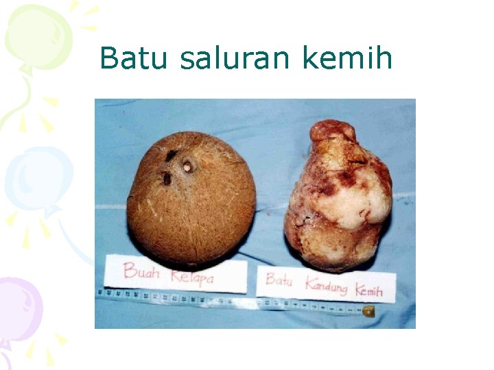 Batu saluran kemih 