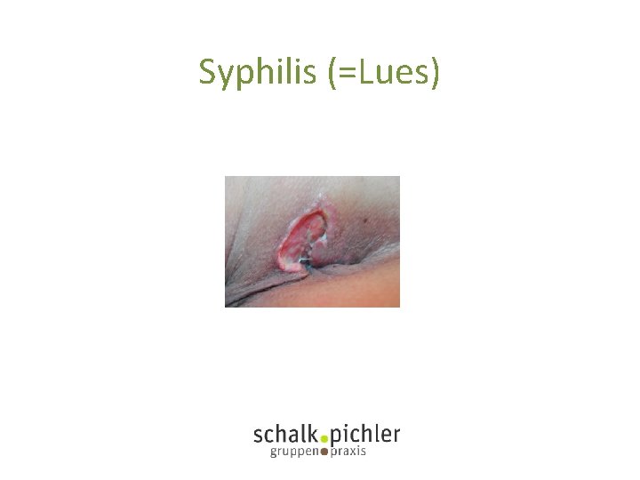 Syphilis (=Lues) 