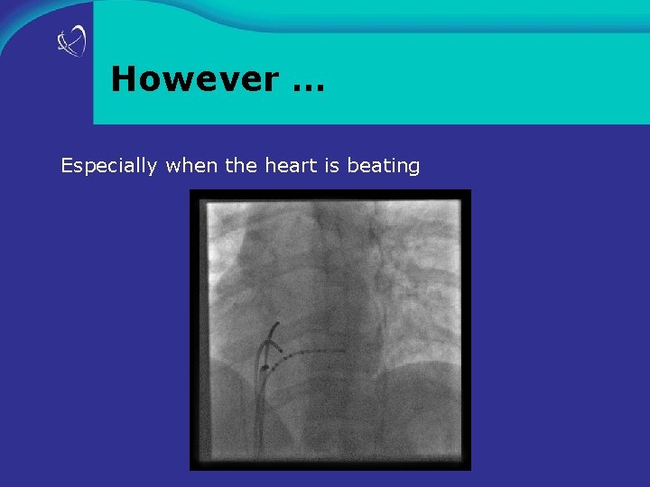 However … Especially when the heart is beating 