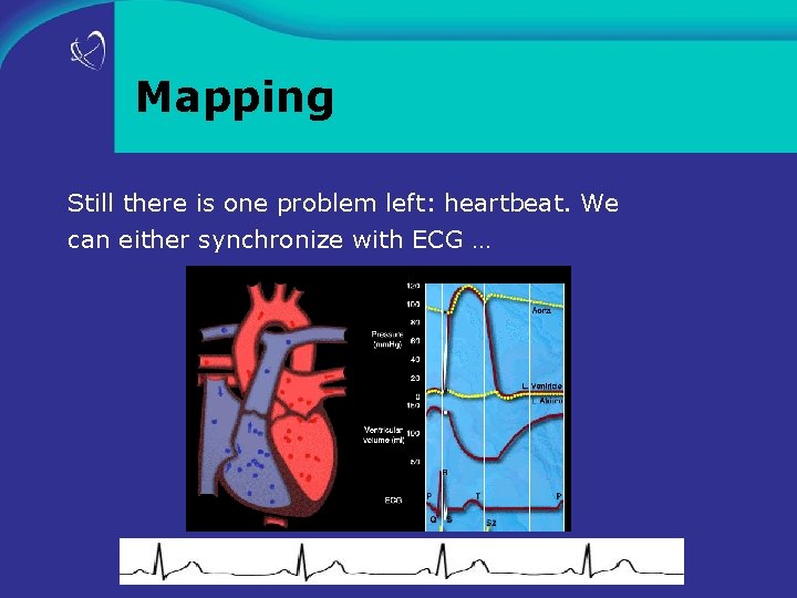 Mapping Still there is one problem left: heartbeat. We can either synchronize with ECG
