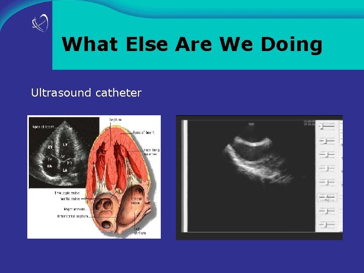 What Else Are We Doing Ultrasound catheter 