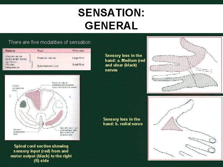 SENSATION: GENERAL There are five modalities of sensation. Sensory loss in the hand: a.