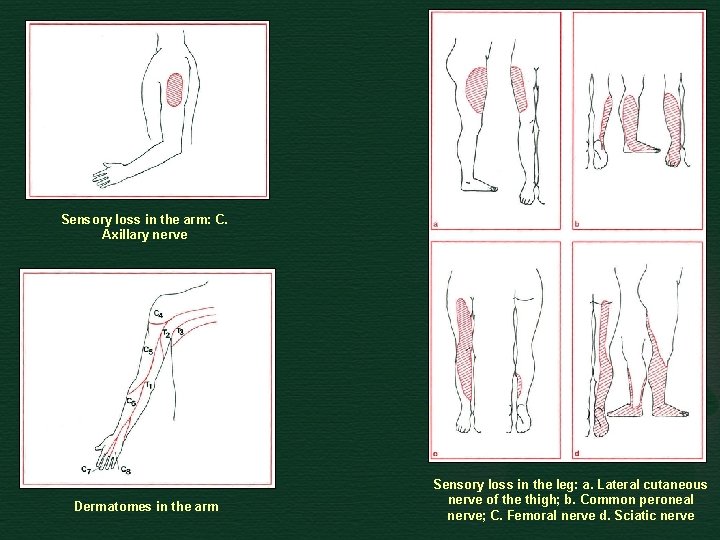 Sensory loss in the arm: C. Axillary nerve Dermatomes in the arm Sensory loss