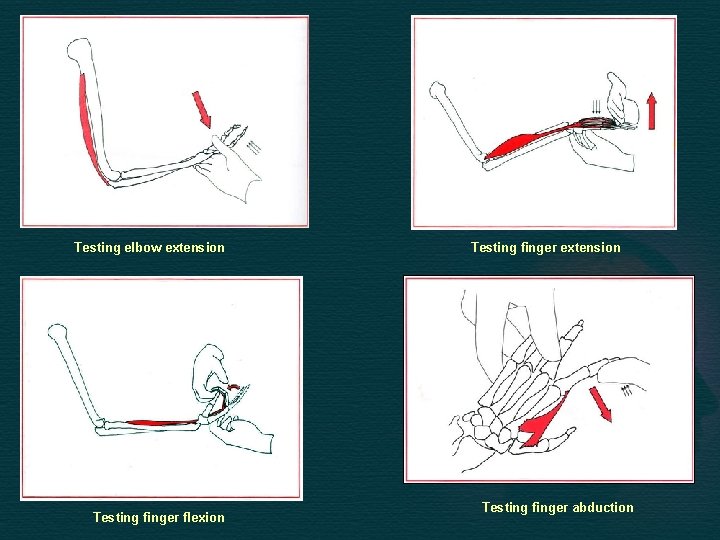 Testing elbow extension Testing finger flexion Testing finger extension Testing finger abduction 
