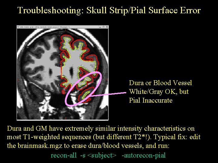 Troubleshooting: Skull Strip/Pial Surface Error Dura or Blood Vessel White/Gray OK, but Pial Inaccurate Troubleshooting: Skull Strip/Pial Surface Error Dura or Blood Vessel White/Gray OK, but Pial Inaccurate