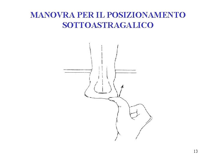 MANOVRA PER IL POSIZIONAMENTO SOTTOASTRAGALICO 13 