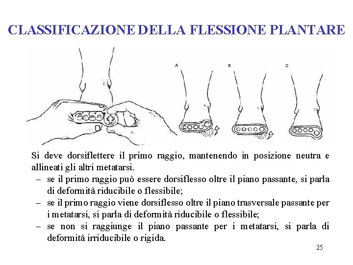 CLASSIFICAZIONE DELLA FLESSIONE PLANTARE Si deve dorsiflettere il primo raggio, mantenendo in posizione neutra