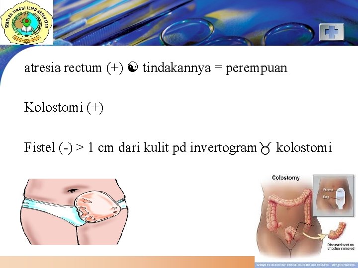 LOGO atresia rectum (+) tindakannya = perempuan Kolostomi (+) Fistel (-) > 1 cm