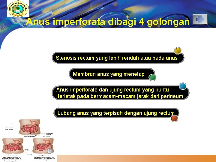 LOGO Anus imperforata dibagi 4 golongan Stenosis rectum yang lebih rendah atau pada anus