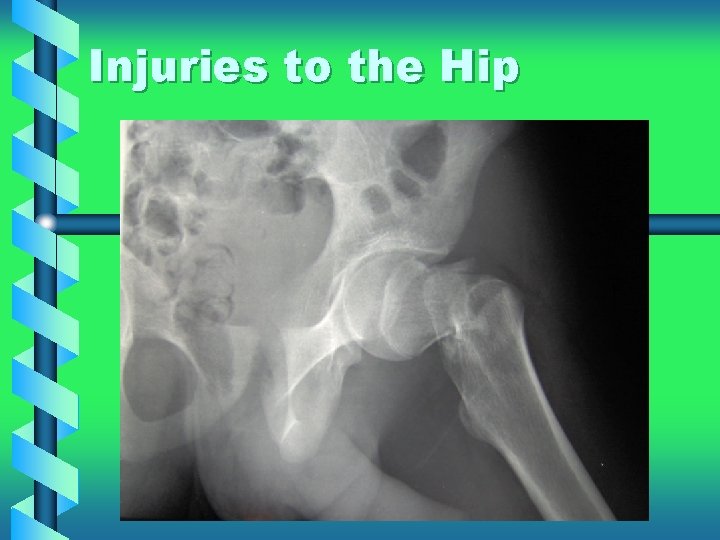 Injuries to the Hip 