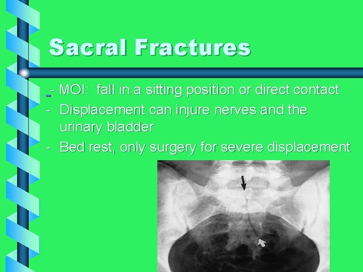 Sacral Fractures - MOI: fall in a sitting position or direct contact - Displacement