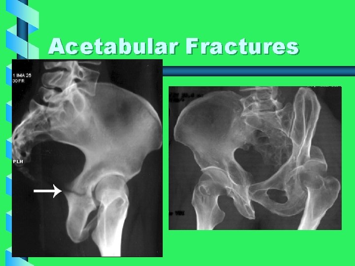Acetabular Fractures 