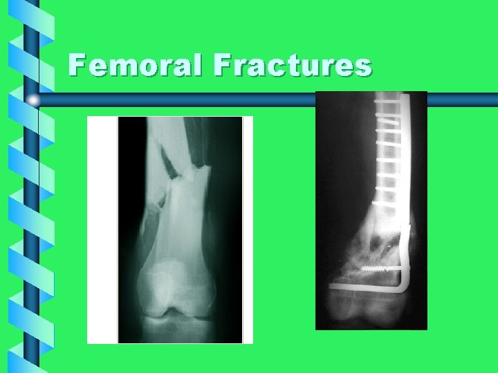Femoral Fractures 