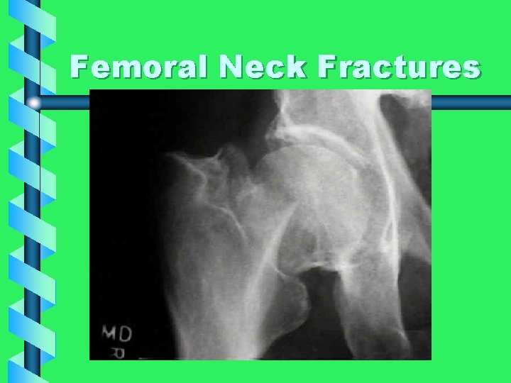 Femoral Neck Fractures 