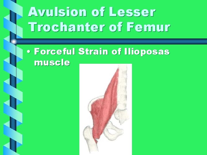 Avulsion of Lesser Trochanter of Femur • Forceful Strain of Ilioposas muscle 