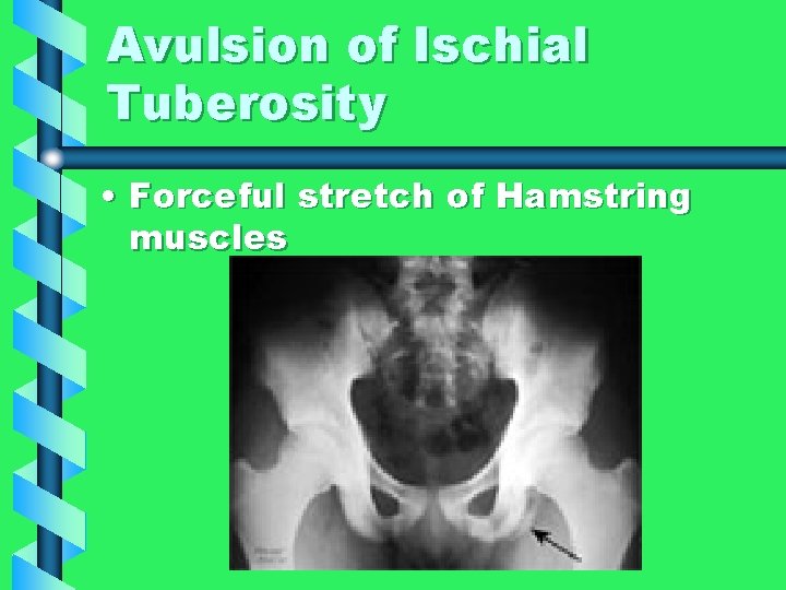 Avulsion of Ischial Tuberosity • Forceful stretch of Hamstring muscles 