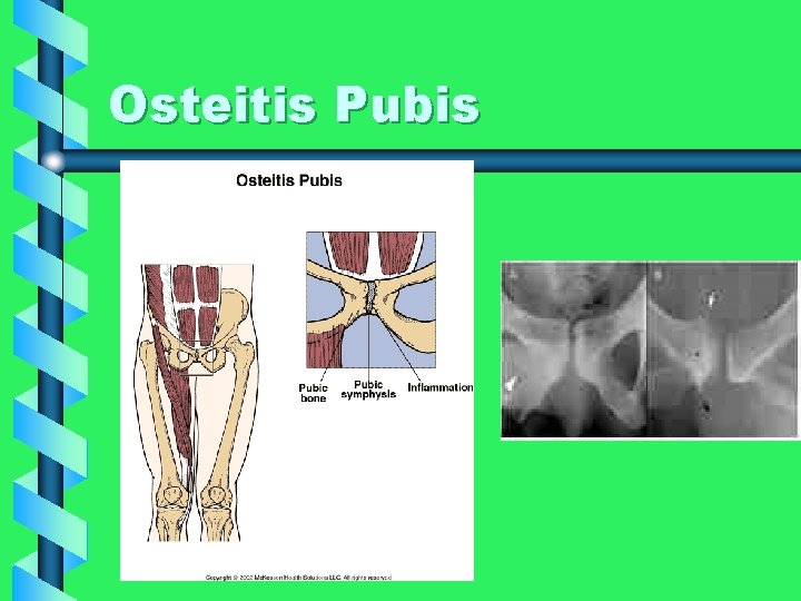 Osteitis Pubis 