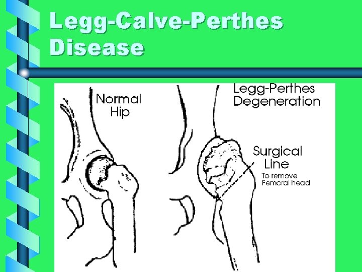 Legg-Calve-Perthes Disease 