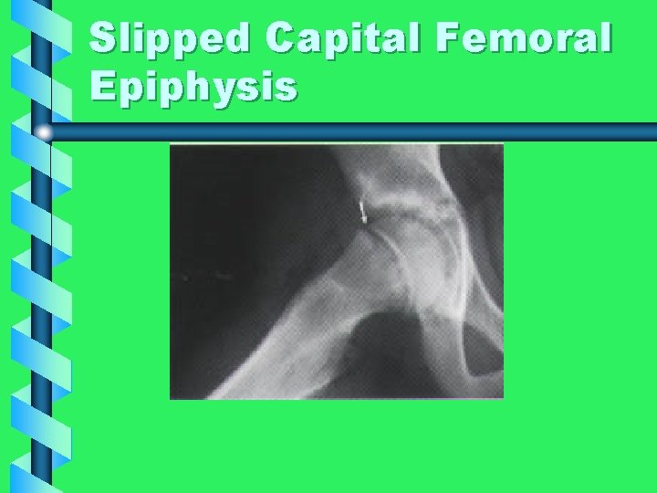 Slipped Capital Femoral Epiphysis 