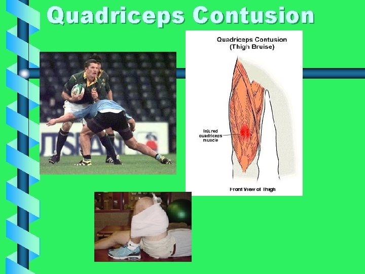 Quadriceps Contusion 
