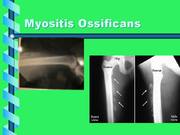 Myositis Ossificans 