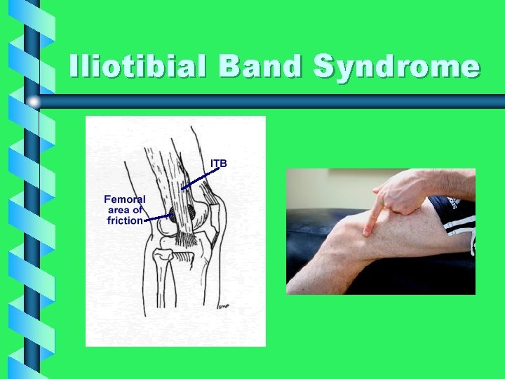 Iliotibial Band Syndrome 