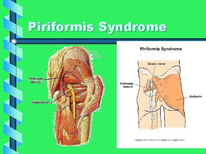 Piriformis Syndrome 