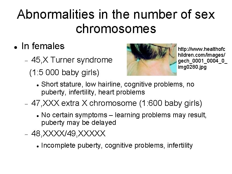 Abnormalities in the number of sex chromosomes In females 45, X Turner syndrome (1: