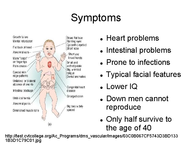 Symptoms Heart problems Intestinal problems Prone to infections Typical facial features Lower IQ Down