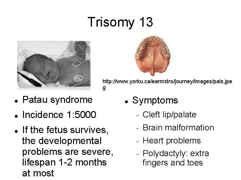 Trisomy 13 http: //www. yorku. ca/earmstro/journey/images/pals. jpe g Patau syndrome Incidence 1: 5000 Cleft