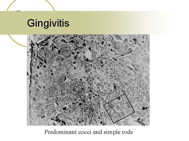 Gingivitis Predominant cocci and simple rods 