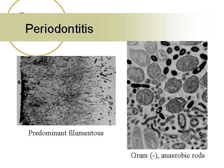 Periodontitis Predominant filamentous Gram (-), anaerobic rods 