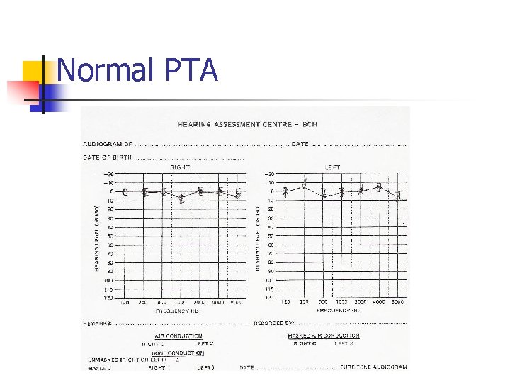 Normal PTA 