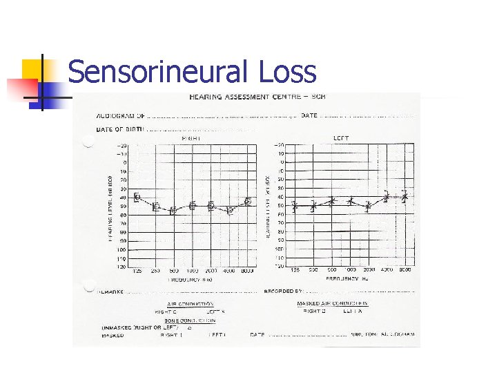 Sensorineural Loss 