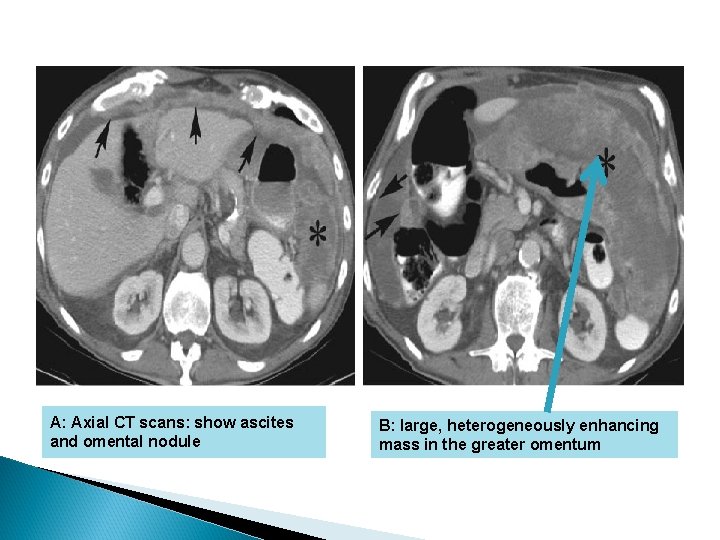 A: Axial CT scans: show ascites and omental nodule B: large, heterogeneously enhancing mass