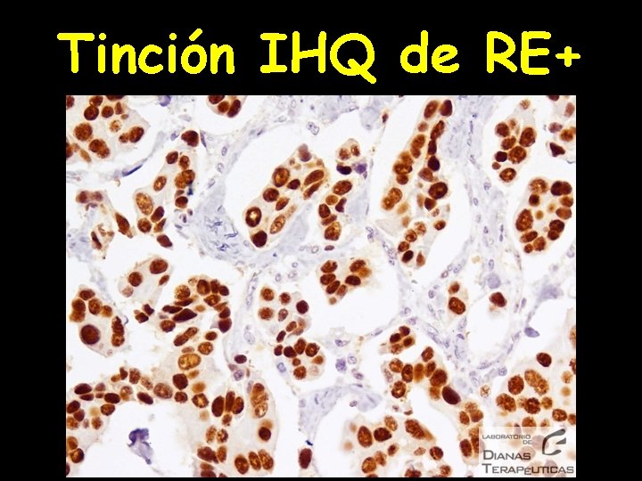 Tinción IHQ de RE+ 