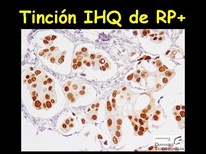 Tinción IHQ de RP+ 