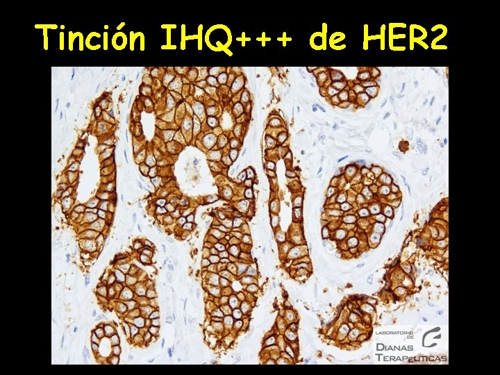 Tinción IHQ+++ de HER 2 