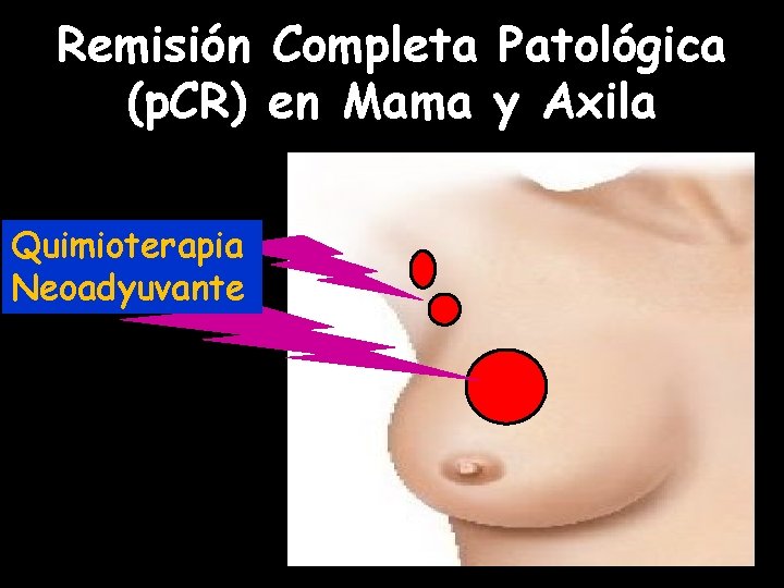 Remisión Completa Patológica (p. CR) en Mama y Axila Quimioterapia Neoadyuvante 