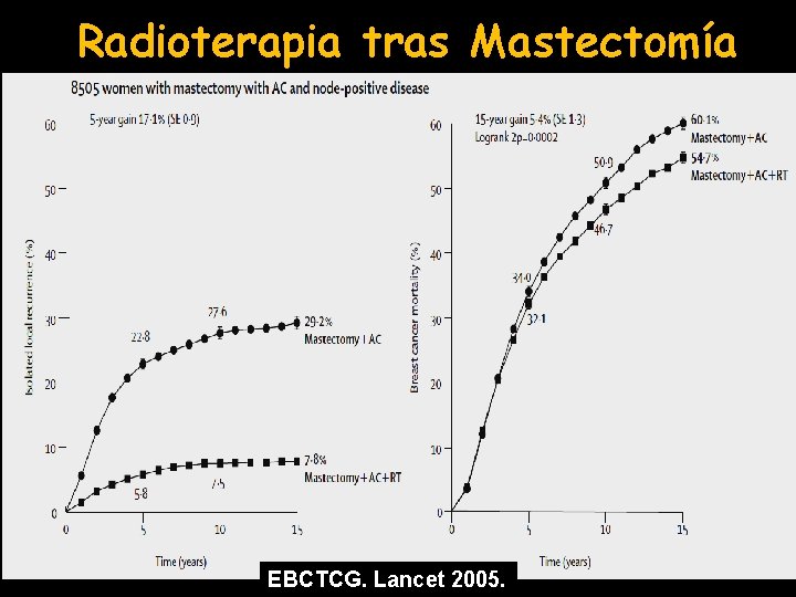 Radioterapia tras Mastectomía EBCTCG. Lancet 2005. 