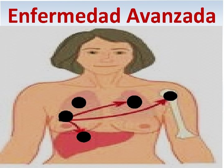 Enfermedad Avanzada HAGA CLIC PARA MODIFICAR EL ESTILO DE TÍTULO DEL PATRÓN 