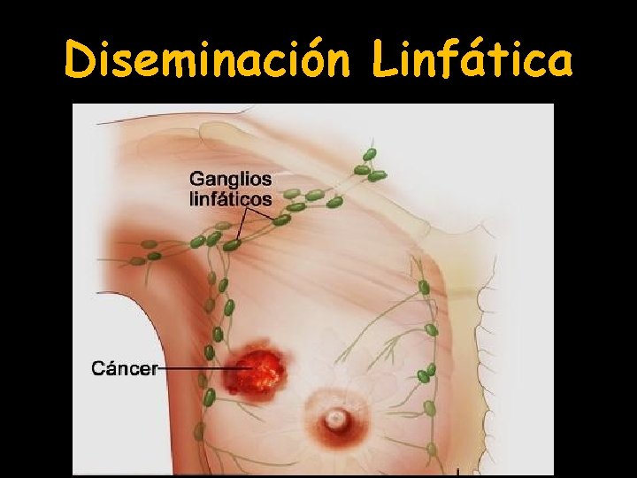 Diseminación Linfática 
