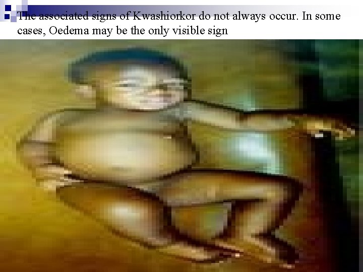 n The associated signs of Kwashiorkor do not always occur. In some cases, Oedema
